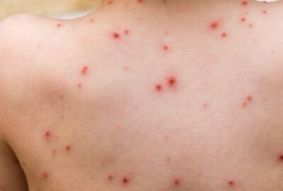 chickenpox spots on a person's back